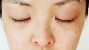 درمان لکه های تیره روی پوست صورت
