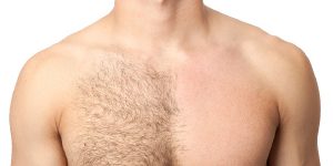 لیزر موهای زائد بدن مردان